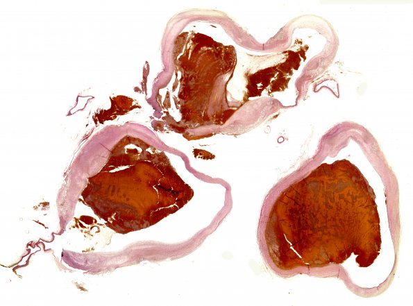 1D1 Arteritis, aneurysm, rupture (Case 1) N11 VVG WM