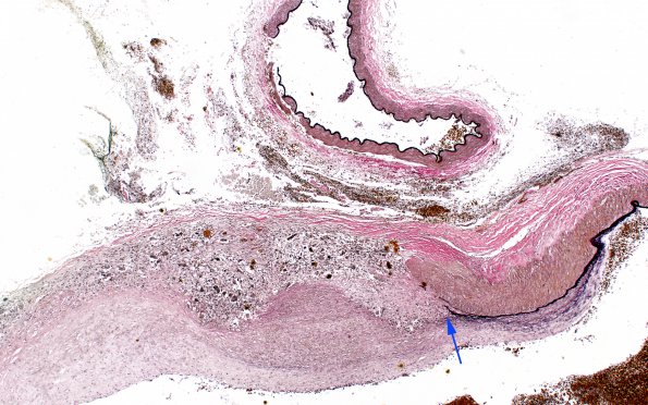 1D3 Arteritis, aneurysm, rupture (Case 1) N11 VVG 4X 2 copy