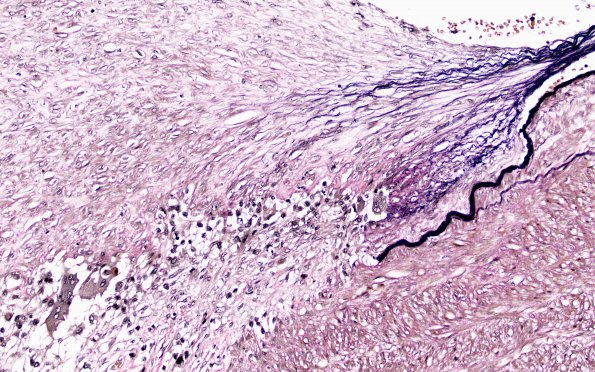 1D5 Arteritis, aneurysm, rupture (Case 1) N11 VVG 20X 2