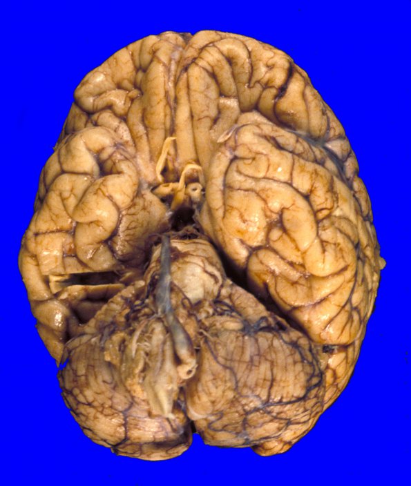 2A1 Giant cell arteritis (Case 2) 6