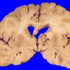 2A2 Giant cell arteritis (Case 2) A4