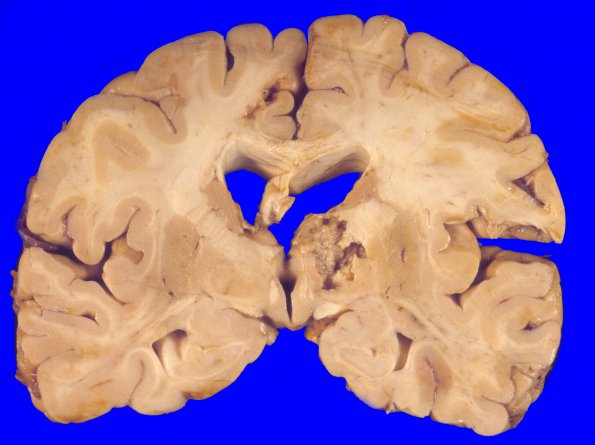 2A2 Giant cell arteritis (Case 2) A4