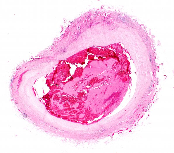 2B1 Giant cell arteritis (Case 2) basilar N11 H&E 2X