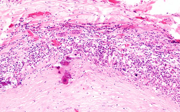 2B2 Giant cell arteritis (Case 2) N11 H&E 20X 3