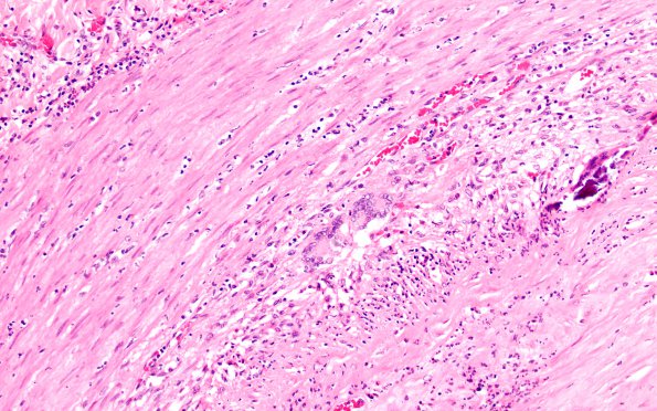 2B3 Giant cell arteritis (Case 2) N11 H&E 20X 4