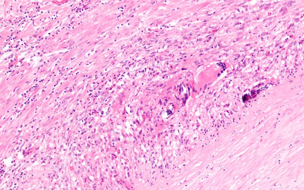 2B4 Giant cell arteritis (Case 2) N11 H&E 20X 5