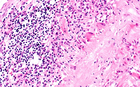 2B5 Giant cell arteritis (Case 2) N11 H&E 40X