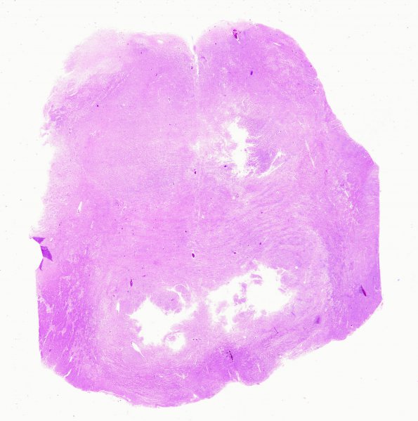 2B6 Giant cell arteritis (Case 2) N13 H&E WM