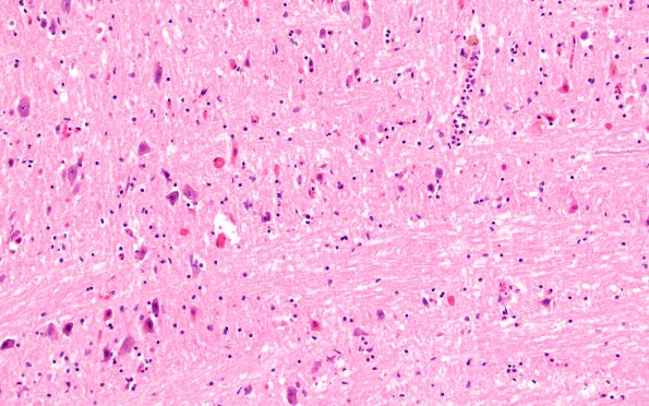 2B7 Giant cell arteritis (Case 2) N13 H&E 20X 2