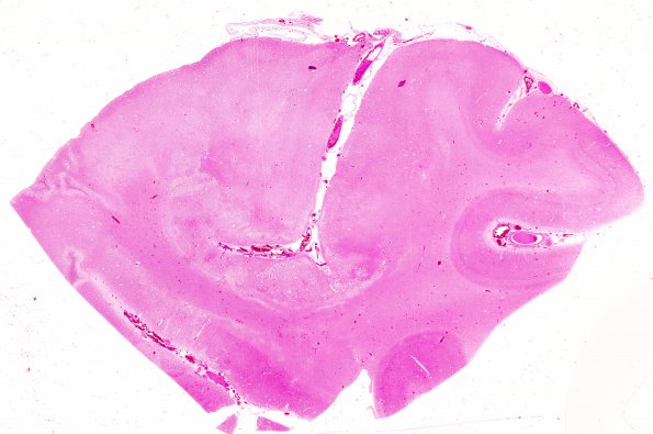 2B8 Giant cell arteritis (Case 2) N5 H&E WM