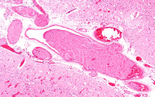 2B9 Giant cell arteritis (Case 2) N5 H&E 10X