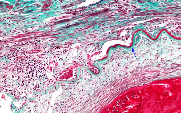 2C2 Giant cell arteritis (Case 2) N11 TRI 40X 2 copy