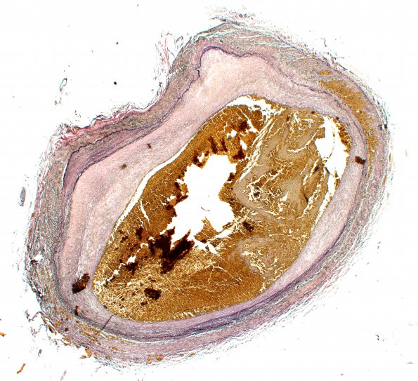 2D1 Giant cell arteritis (Case 2) N11 VVG 2X 2