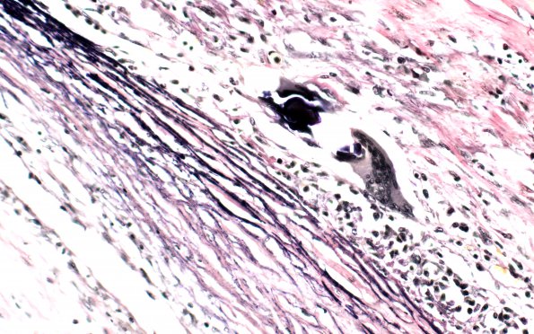 2D4 Giant cell arteritis (Case 2) N11 VVG 40X 2