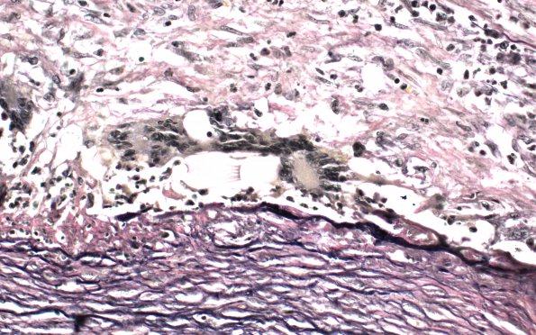 2D5 Giant cell arteritis (Case 2) N11 VVG 40X