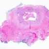 3A1 Vasculitis, Giant Cell Temporal Arteritis (Case 3) 2.