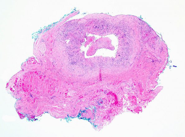 3A1 Vasculitis, Giant Cell Temporal Arteritis (Case 3) 2.