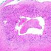 3A2 Vasculitis, Giant Cell Temporal Arteritis (Case 3) 3