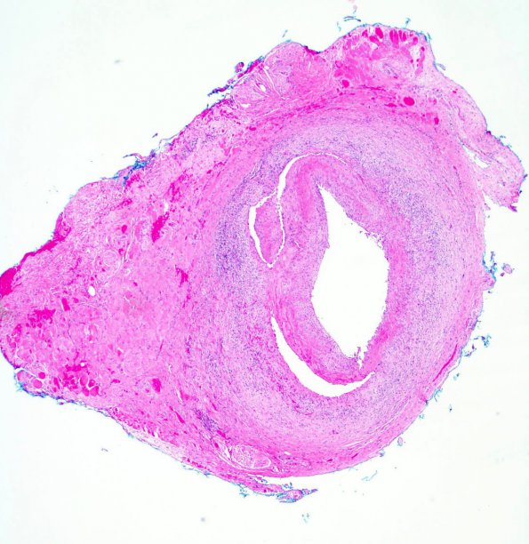 3A3 Vasculitis, Giant Cell Temporal Arteritis (Case 3) 1