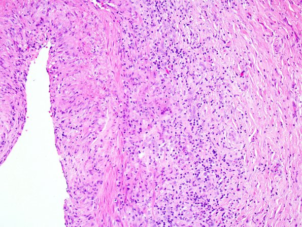 3A4 Vasculitis, Giant Cell Temporal Arteritis (Case 3) 4