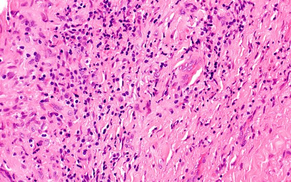 3A5 Vasculitis, Giant Cell Temporal Arteritis (Case 3) H&E 3