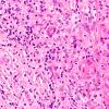 3A6 Vasculitis, Giant Cell Temporal Arteritis (Case 3) H&E 1