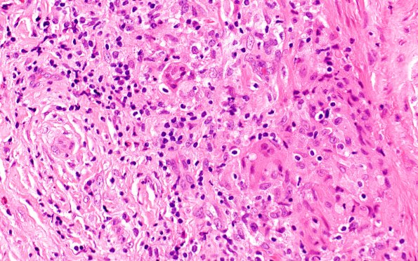 3A6 Vasculitis, Giant Cell Temporal Arteritis (Case 3) H&E 1