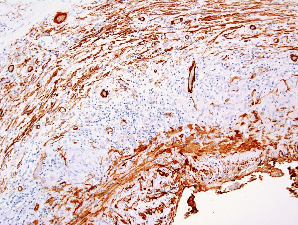 3B2 Vasculitis, Giant Cell Temporal Arteritis (Case 3) SMA 3