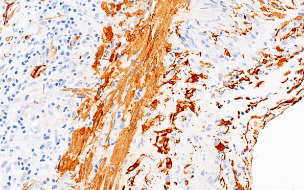 3B3 Vasculitis, Giant Cell Temporal Arteritis (Case 3) SMA 40X 2