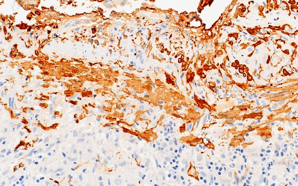 3B4 Vasculitis, Giant Cell Temporal Arteritis (Case 3) SMA 40X 3