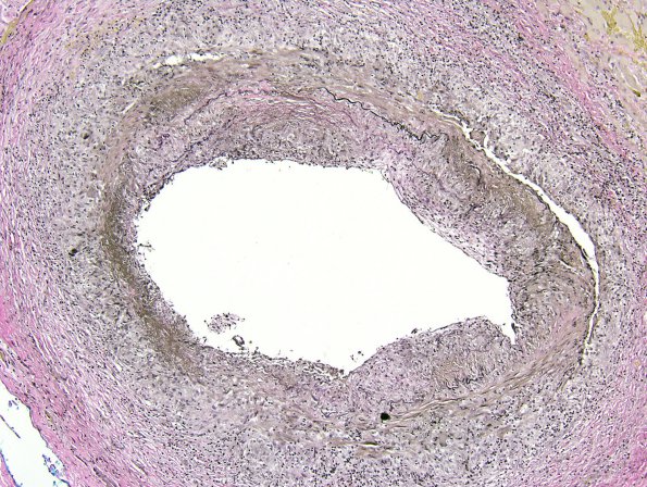 3C1 Vasculitis, Giant Cell Temporal Arteritis (Case 3) VVG 1