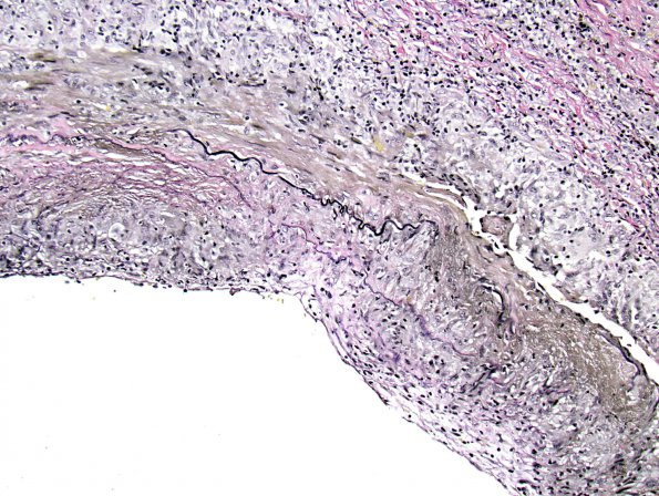 3C2 Vasculitis, Giant Cell Temporal Arteritis (Case 3) VVG 2