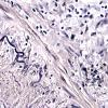 3C3 Vasculitis, Giant Cell Temporal Arteritis (Case 3) VVG 60X 1