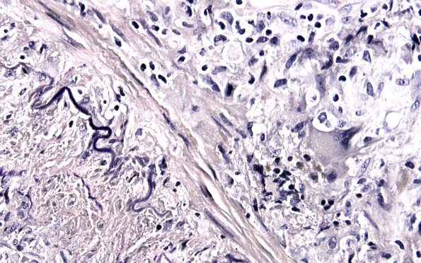 3C3 Vasculitis, Giant Cell Temporal Arteritis (Case 3) VVG 60X 1