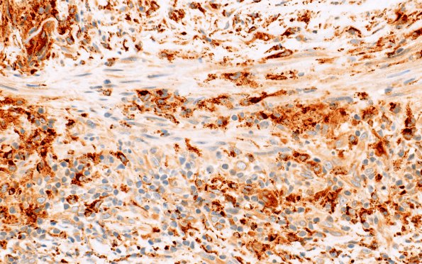 3D3 Vasculitis, Giant Cell Temporal Arteritis (Case 3) between CD68