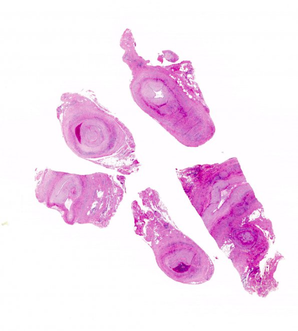 4A1 Vasculitis, Temporal Giant Cell Arteritis (Case 4) H&E WM 1