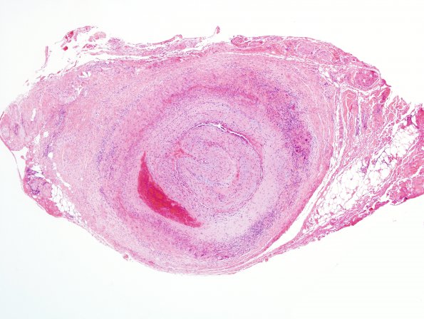 4A2 Vasculitis, temporal artery, (Case 4) H&E 2