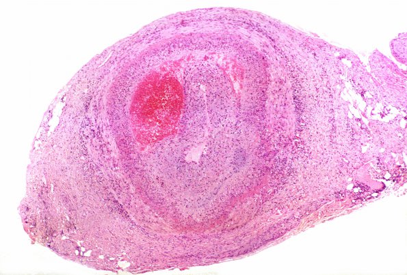 4A3 Vasculitis, Temporal Giant Cell Arteritis 1a (Case 4)