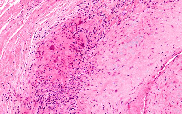 4A5 Vasculitis, Temporal Giant Cell Arteritis (Case 4) H&E 20X 2