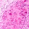 4A6 Vasculitis, Temporal Giant Cell Arteritis (Case 4) H&E 40X 2