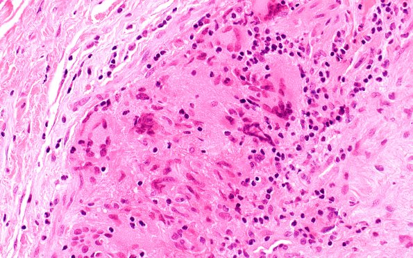 4A6 Vasculitis, Temporal Giant Cell Arteritis (Case 4) H&E 40X 2