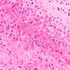 4A7 Vasculitis, Temporal Giant Cell Arteritis (Case 4) H&E 40X copy