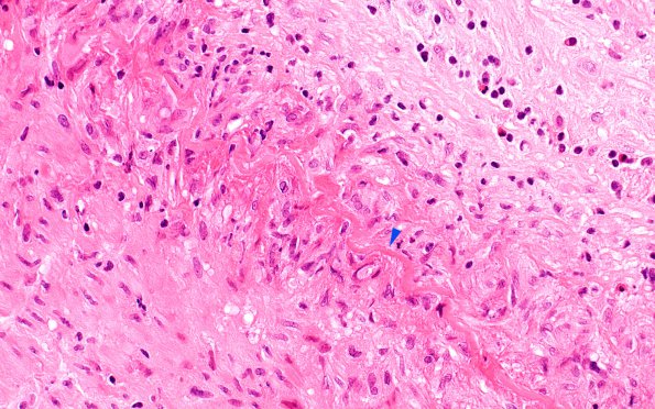 4A7 Vasculitis, Temporal Giant Cell Arteritis (Case 4) H&E 40X copy