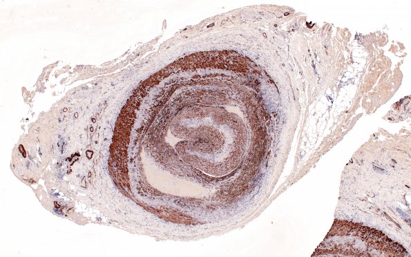 4B1 Vasculitis, Temporal Giant Cell Arteritis (Case 4) SMA 4X