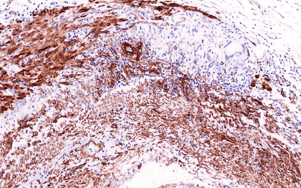 4B2 Vasculitis, Temporal Giant Cell Arteritis (Case 4) SMA 20X