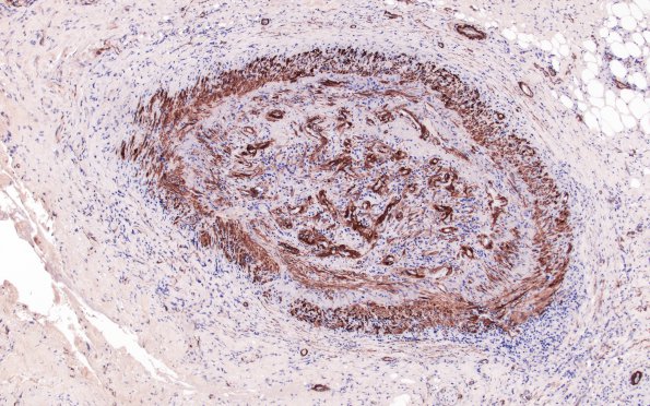 4B3 Vasculitis, Temporal Giant Cell Arteritis (Case 4) SMA 10X