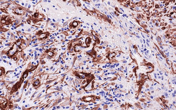 4B4 Vasculitis, Temporal Giant Cell Arteritis (Case 4) SMA 40X 2