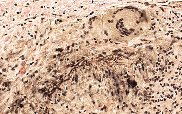 4C4 Vasculitis, Temporal Giant Cell Arteritis (Case 4) VVG 40X 2