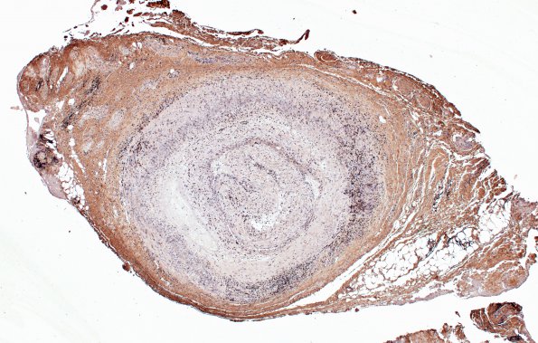 4D1 Vasculitis, Temporal Giant Cell Arteritis (Case 4) CD3 4X 3