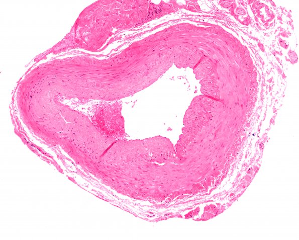 5A1 Vasculitis, temporal artery, healed (Case 5) 10X